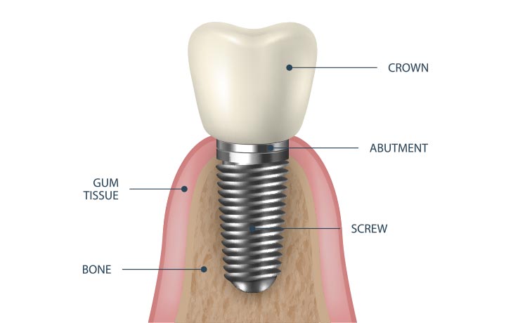 Dental Implants, Replacing Missing Teeth