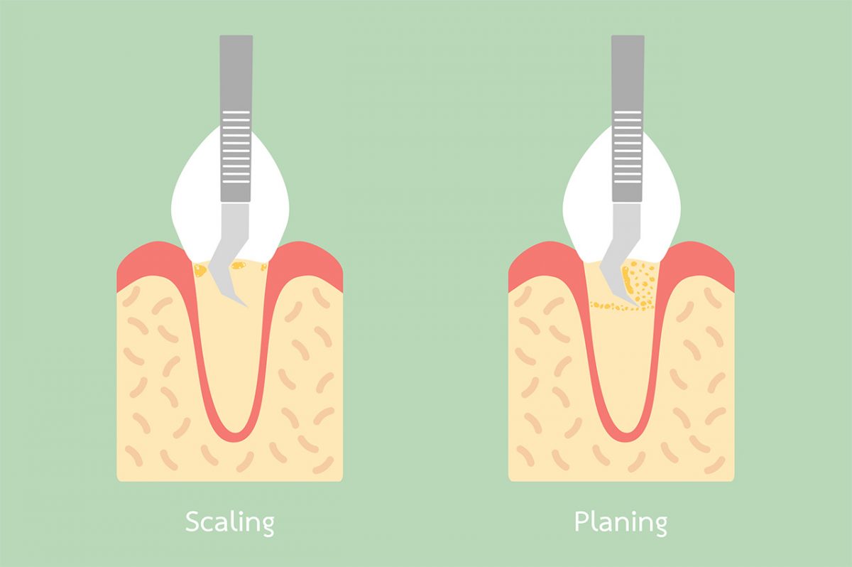 Scaling & Root Planing Northlake Periodontics Procedures